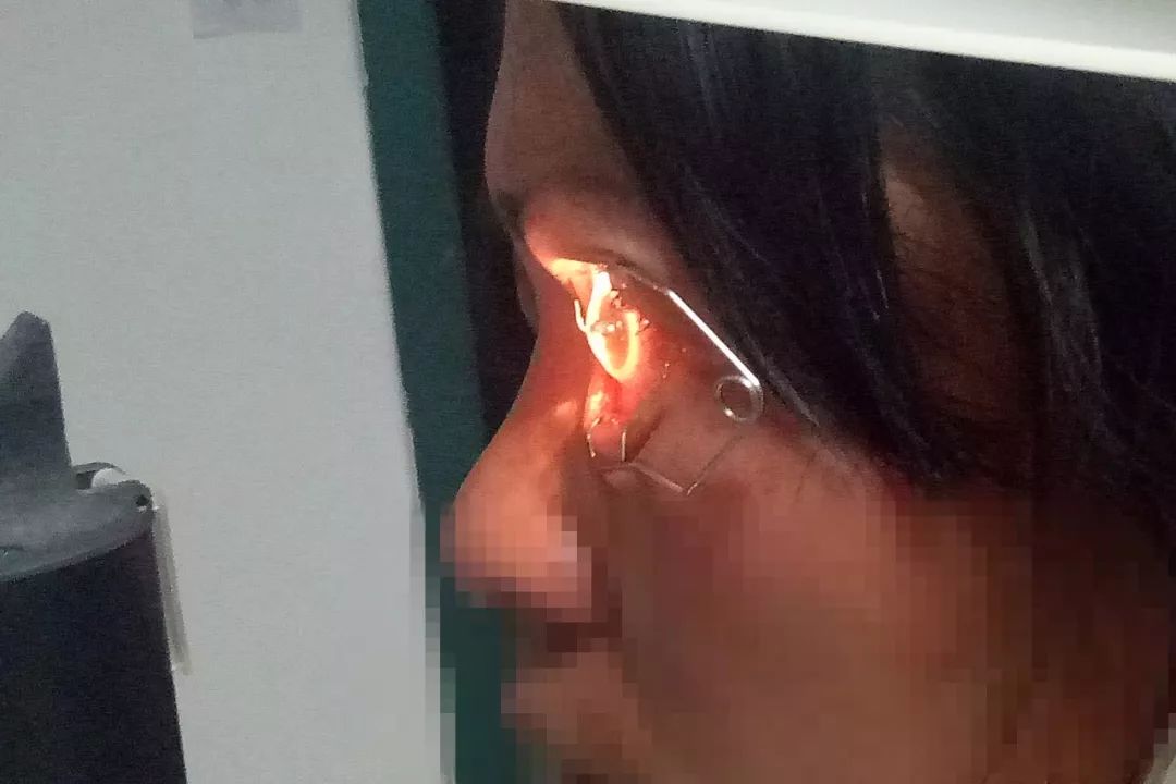 37歲女工眼球穿通傷，專家：越早就醫(yī)越好