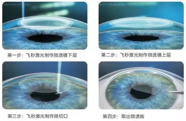 @近視黨，這周天近視手術(shù)交流會(huì)邀你參加
